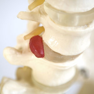 Spine model showing a ruptured disc pressing on a nerve