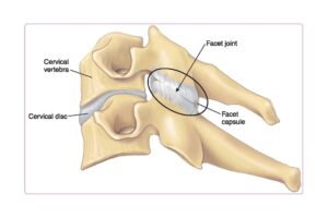 Anatomical diagram of two cervical vertebrae showing the facet joint, facet capsule, cervical disc, and vertebral body