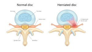 Diagram comparing a normal spinal disc with an intact annulus and nucleus to a herniated disc with nucleus material compressing a nerve root