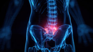 Digital illustration of the lumbar spine and pelvis highlighting the sacroiliac joint area as a source of lower back pain