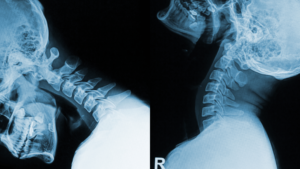 Flexion and extension cervical spine X-rays used to assess ligament stability and spinal motion