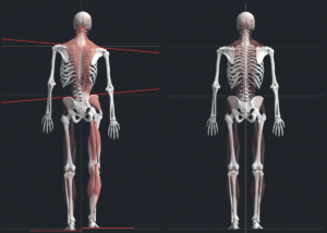 full misalignment anatomical illustration representing the whole-spine impact of upper cervical misalignment