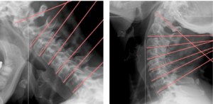 Screenshot 2026-05-27 at 12.48.42 PM Cervical spine X-rays showing structural damage from a motor vehicle accident