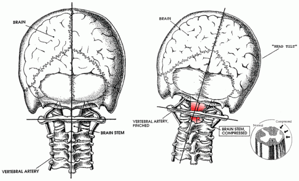 norm-and-abnorm-brainstem-compress-600x364 Diagram comparing a properly aligned upper cervical spine to a misaligned one showing how atlas misalignment can compress the brainstem